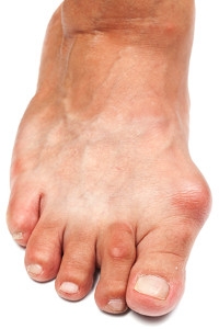 Can Bunions Be Prevented?