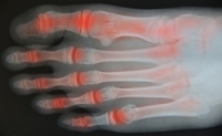 Is Rheumatoid Arthritis Common?