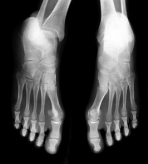 How to Treat and Prevent Stress Fractures of the Feet