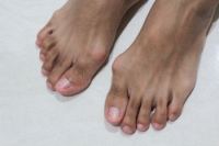 Causes and Treatment of Bunions