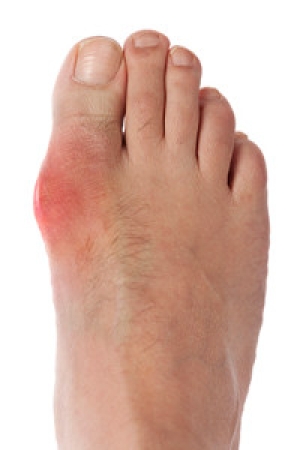 Diet and Gout