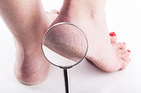The Causes of Cracked Heels