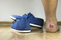 Infections From Foot Blisters