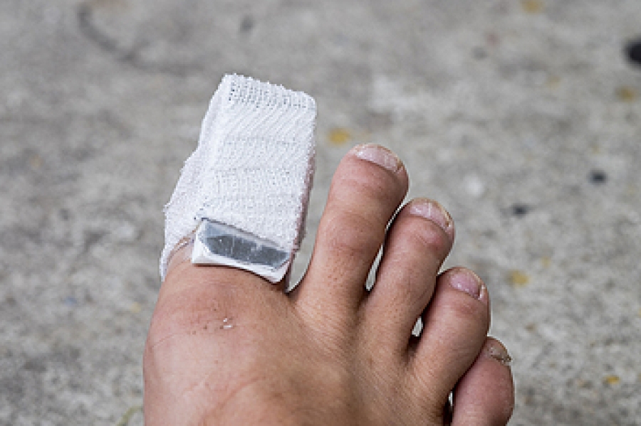 How to Tell If You Have a Broken Toe