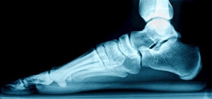 Characteristics and Causes of Flat Feet