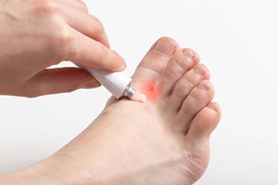 Athlete's Foot Treatment | U.S. Dermatology Partners